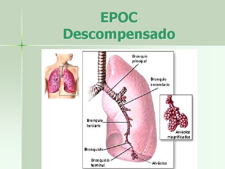 EPOC Descompensado 