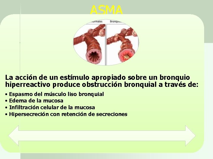 ASMA La acción de un estímulo apropiado sobre un bronquio hiperreactivo produce obstrucción bronquial