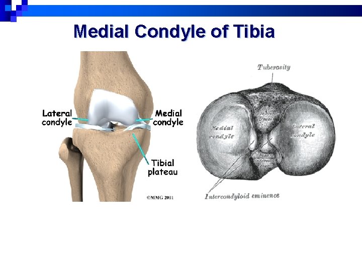 Medial Condyle of Tibia 