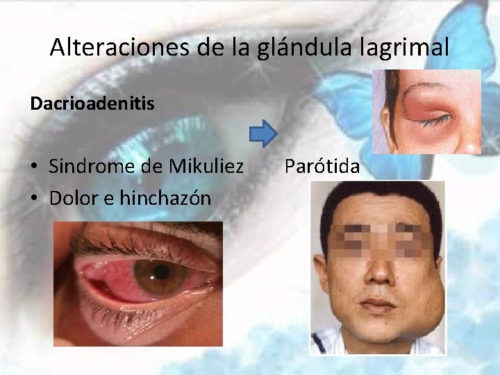 Alteraciones de la glándula lagrimal Dacrioadenitis • Sindrome de Mikuliez • Dolor e hinchazón
