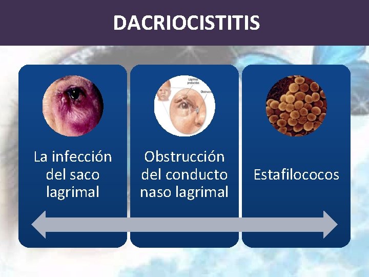 DACRIOCISTITIS La infección del saco lagrimal Obstrucción del conducto naso lagrimal Estafilococos 