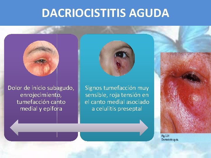 DACRIOCISTITIS AGUDA Dolor de inicio subagudo, enrojecimiento, tumefacción canto medial y epifora Signos tumefacción