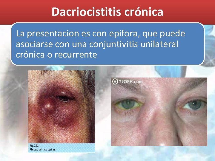 Dacriocistitis crónica La presentacion es con epifora, que puede asociarse con una conjuntivitis unilateral