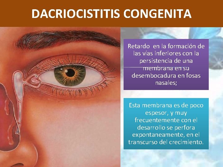 DACRIOCISTITIS CONGENITA Retardo en la formación de las vías inferiores con la persistencia de