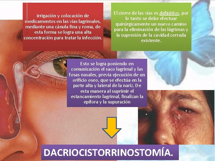 irrigación y colocación de medicamentos en las vías lagrimales, mediante una cánula fina y
