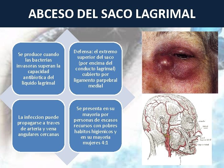 ABCESO DEL SACO LAGRIMAL Se produce cuando las bacterias invasoras superan la capacidad antibiotica