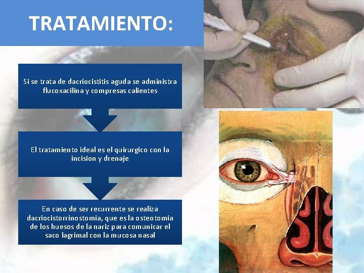 TRATAMIENTO: Si se trata de dacriocistitis aguda se administra flucoxacilina y compresas calientes El