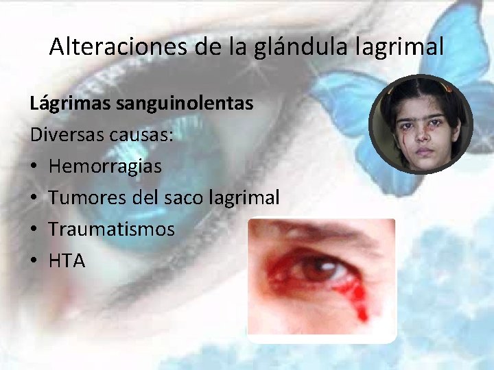 Alteraciones de la glándula lagrimal Lágrimas sanguinolentas Diversas causas: • Hemorragias • Tumores del