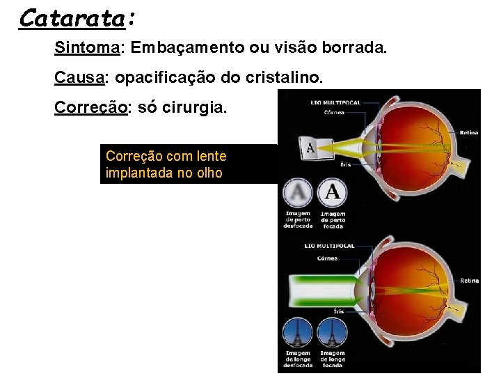 Catarata: Sintoma: Embaçamento ou visão borrada. Causa: opacificação do cristalino. Correção: só cirurgia. Correção