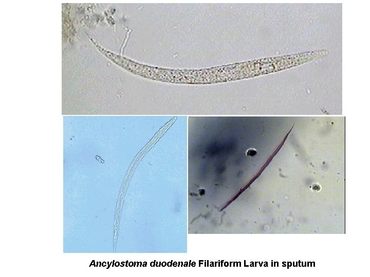 Ancylostoma duodenale Filariform Larva in sputum 