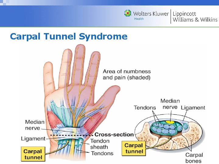 Carpal Tunnel Syndrome Copyright © 2009 Wolters Kluwer Health | Lippincott Williams & Wilkins