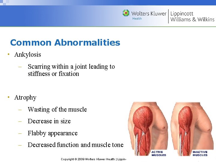 Common Abnormalities • Ankylosis – Scarring within a joint leading to stiffness or fixation