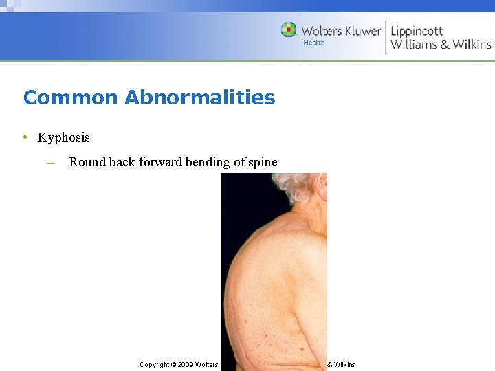 Common Abnormalities • Kyphosis – Round back forward bending of spine Copyright © 2009