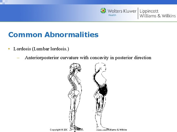 Common Abnormalities • Lordosis (Lumbar lordosis. ) – Anteriorposterior curvature with concavity in posterior