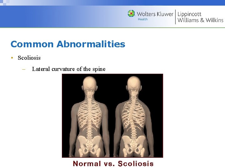 Common Abnormalities • Scoliosis – Lateral curvature of the spine Copyright © 2009 Wolters