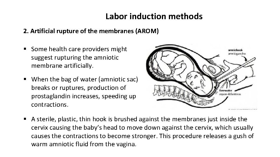 Labor induction methods 2. Artificial rupture of the membranes (AROM) § Some health care