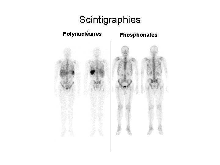 Scintigraphies Polynucléaires Phosphonates 