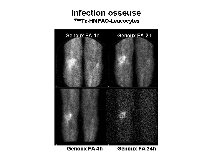 Infection osseuse 99 m. Tc-HMPAO-Leucocytes Genoux FA 1 h Genoux FA 2 h Genoux