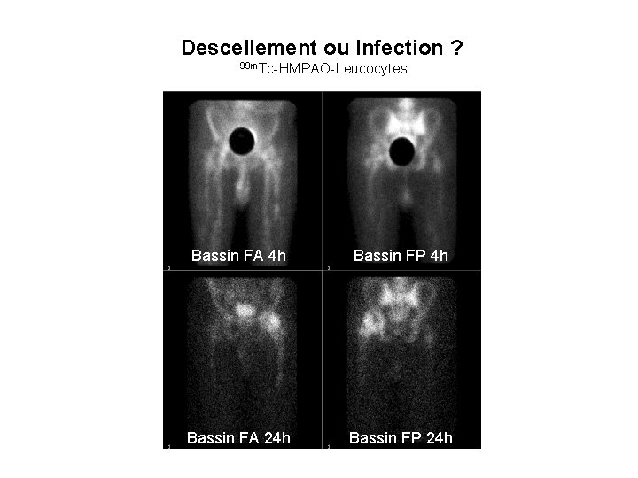 Descellement ou Infection ? 99 m. Tc-HMPAO-Leucocytes Bassin FA 4 h Bassin FP 4