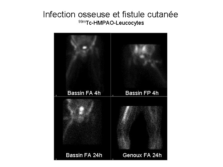 Infection osseuse et fistule cutanée 99 m. Tc-HMPAO-Leucocytes Bassin FA 4 h Bassin FP