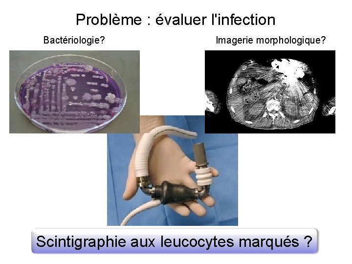 Problème : évaluer l'infection Bactériologie? Imagerie morphologique? Scintigraphie aux leucocytes marqués ? 