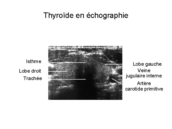 Thyroïde en échographie Isthme Lobe droit Trachée Lobe gauche Veine jugulaire interne Artère carotide