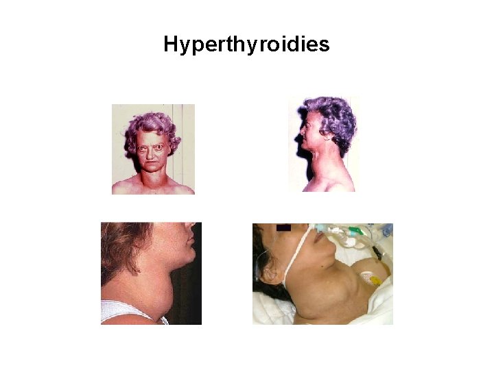 Hyperthyroidies 