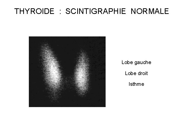 THYROIDE : SCINTIGRAPHIE NORMALE Lobe gauche Lobe droit Isthme 