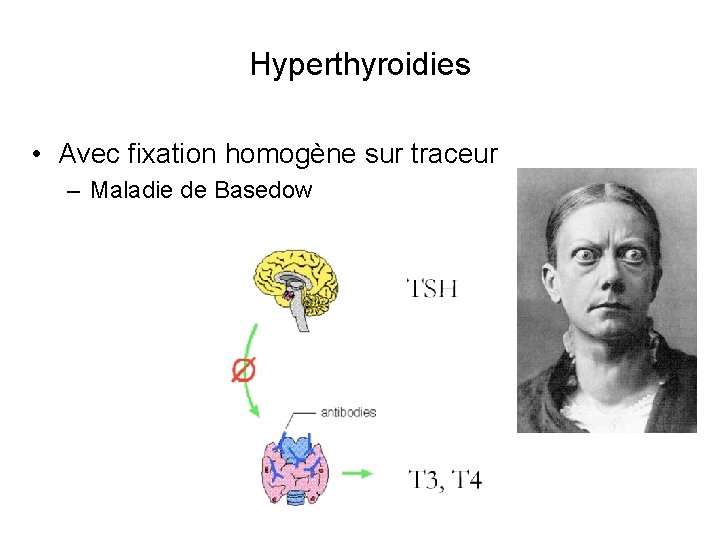 Hyperthyroidies • Avec fixation homogène sur traceur – Maladie de Basedow 