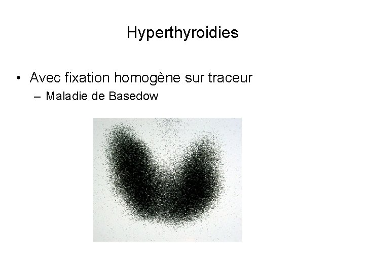 Hyperthyroidies • Avec fixation homogène sur traceur – Maladie de Basedow 