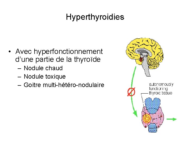 Hyperthyroidies • Avec hyperfonctionnement d’une partie de la thyroïde – Nodule chaud – Nodule