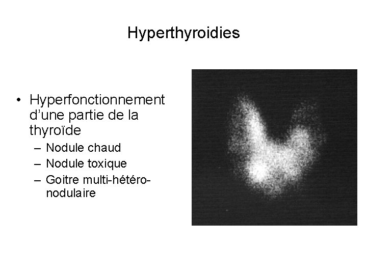 Hyperthyroidies • Hyperfonctionnement d’une partie de la thyroïde – Nodule chaud – Nodule toxique