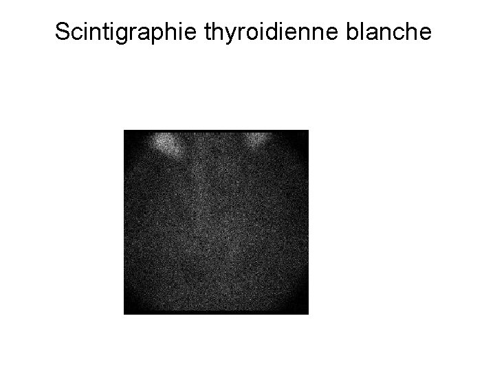 Scintigraphie thyroidienne blanche 