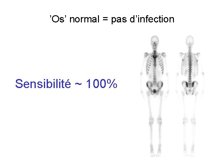 ’Os’ normal = pas d’infection Sensibilité ~ 100% 