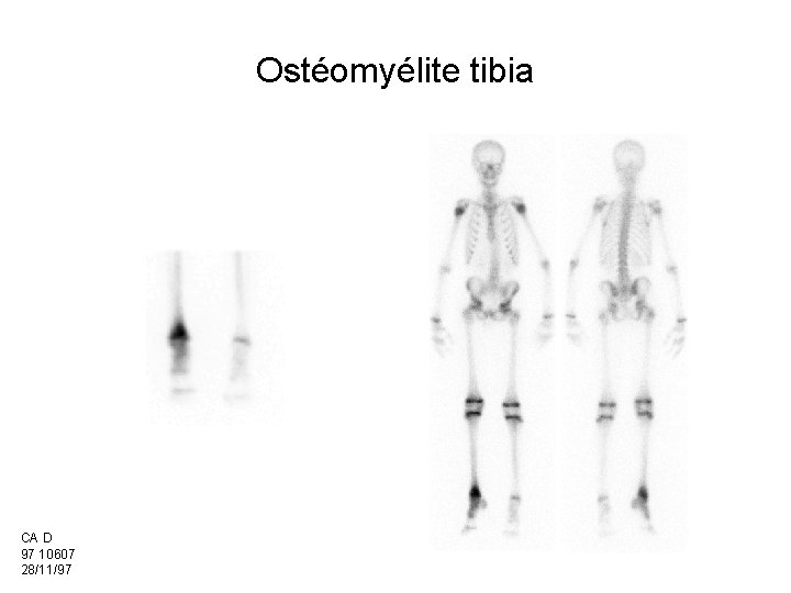 Ostéomyélite tibia CA D 97 10607 28/11/97 
