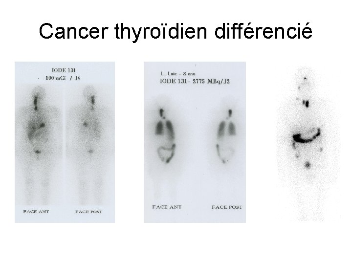 Cancer thyroïdien différencié 