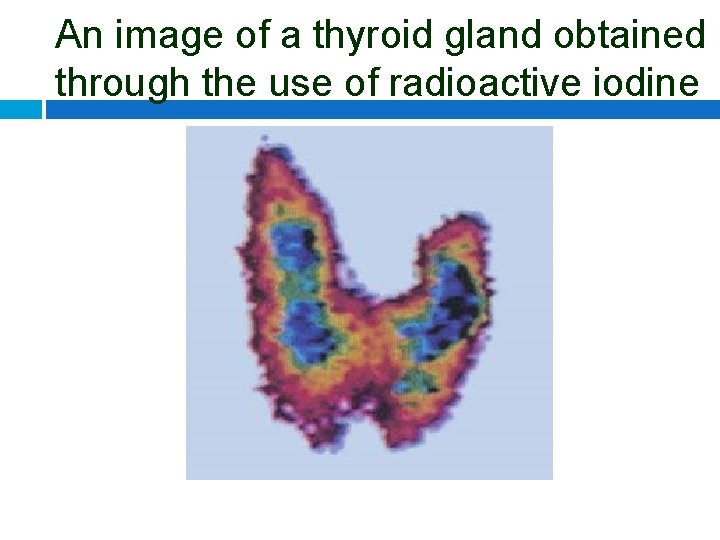 An image of a thyroid gland obtained through the use of radioactive iodine 