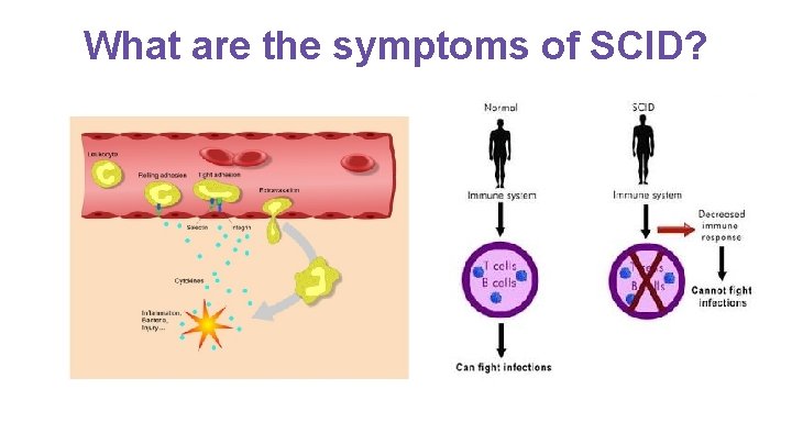 What are the symptoms of SCID? 
