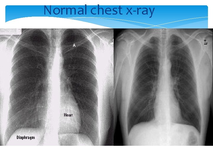 Normal chest x-ray 