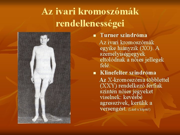 Az ivari kromoszómák rendellenességei n n Turner szindróma Az ivari kromoszómák egyike hiányzik (XO).