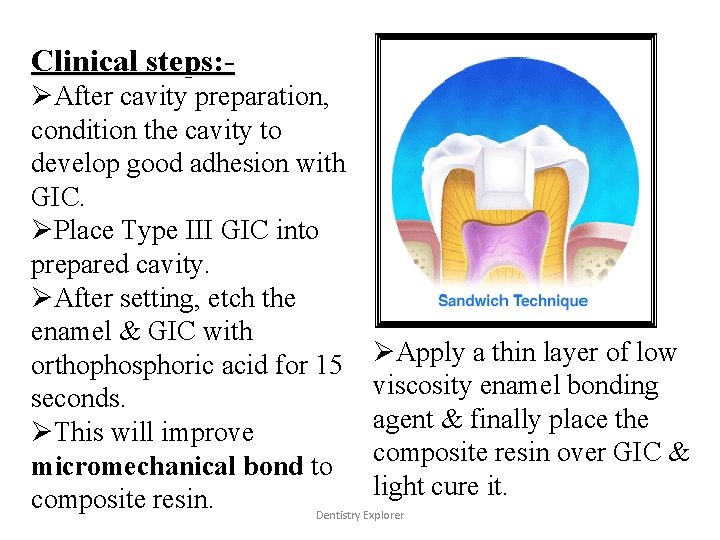 Clinical steps: ØAfter cavity preparation, condition the cavity to develop good adhesion with GIC.