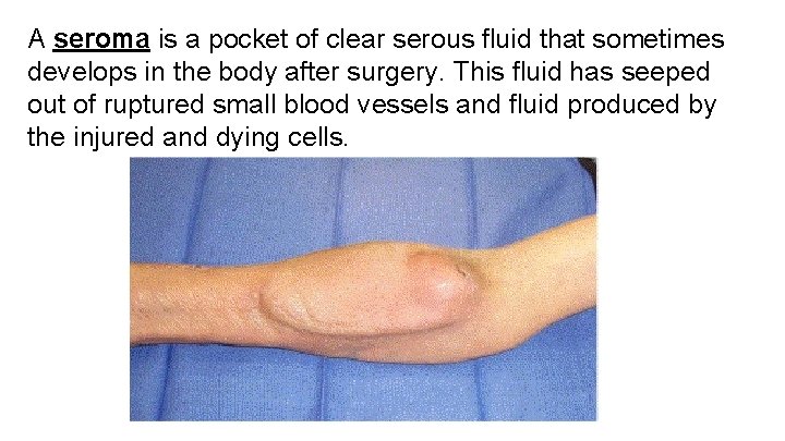 A seroma is a pocket of clear serous fluid that sometimes develops in the A seroma is a pocket of clear serous fluid that sometimes develops in the