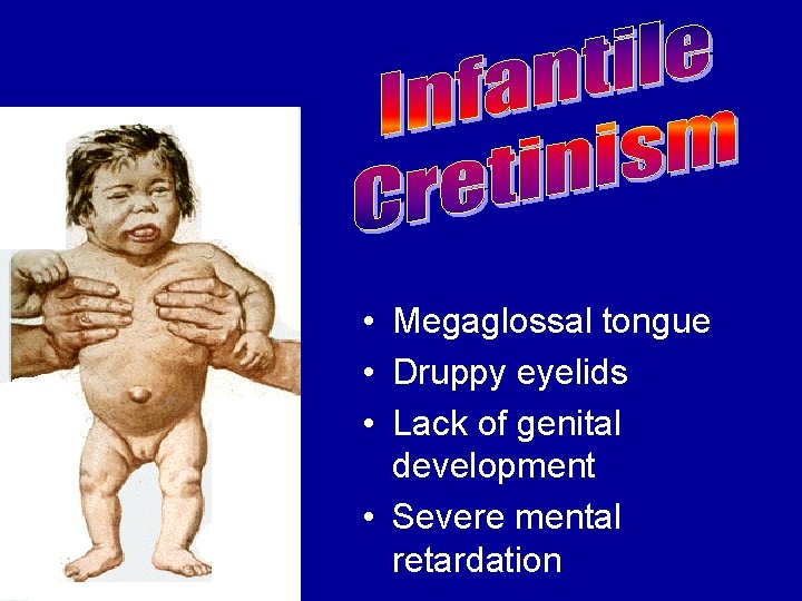  • Megaglossal tongue • Druppy eyelids • Lack of genital development • Severe