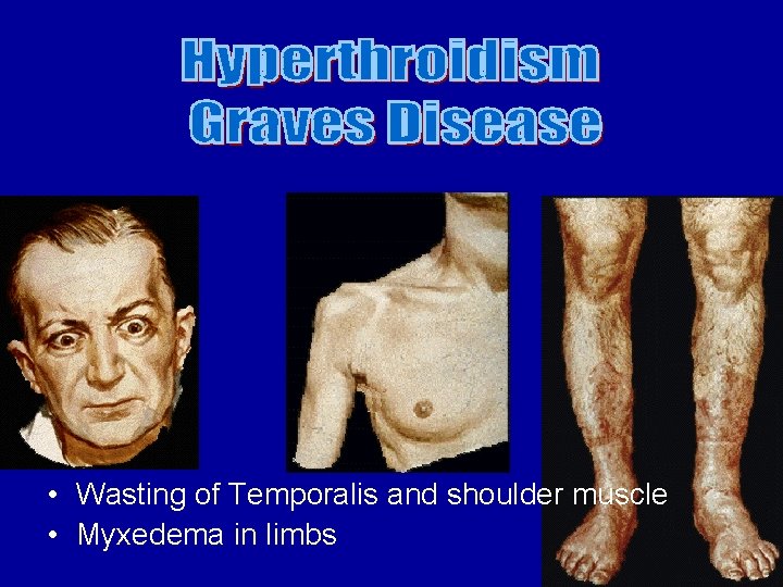  • Wasting of Temporalis and shoulder muscle • Myxedema in limbs 