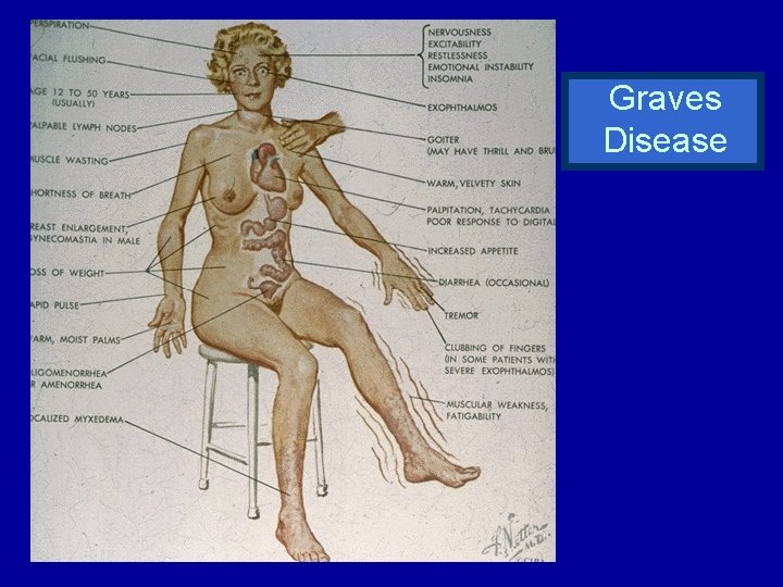 Graves Disease 