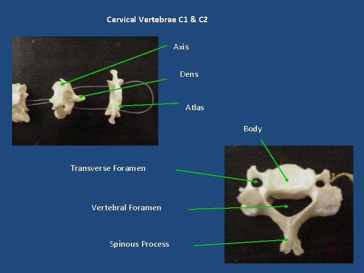 Cervical Vertebrae C 1 & C 2 Axis Dens Atlas Body Transverse Foramen Vertebral