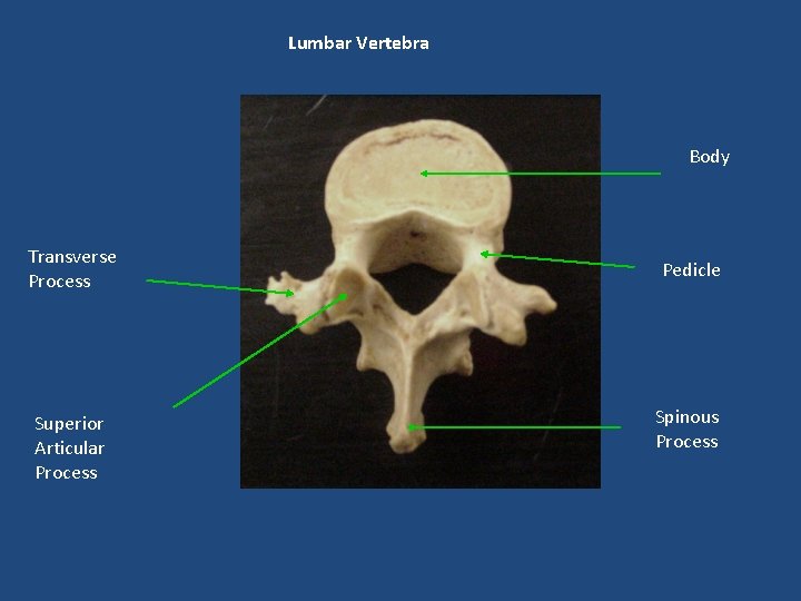 Lumbar Vertebra Body Transverse Process Superior Articular Process Pedicle Spinous Process 