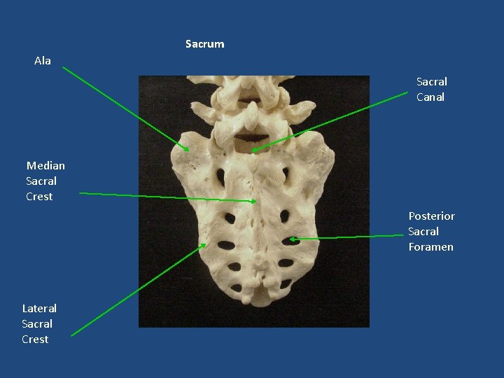 Sacrum Ala Sacral Canal Median Sacral Crest Posterior Sacral Foramen Lateral Sacral Crest 