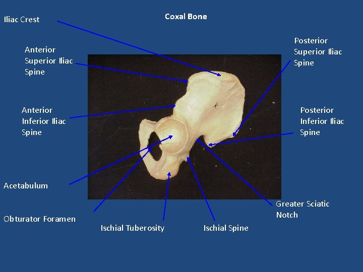 Coxal Bone Iliac Crest Posterior Superior Iliac Spine Anterior Inferior Iliac Spine Posterior Inferior