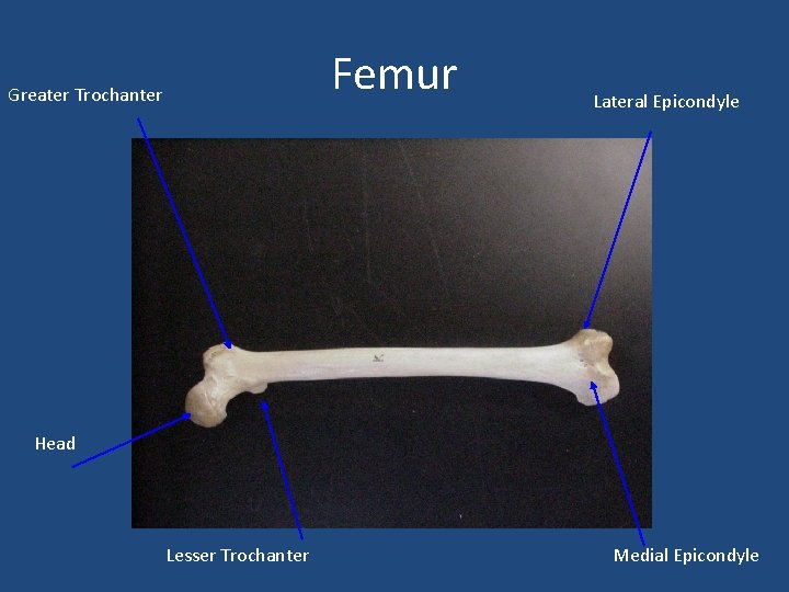 Femur Greater Trochanter Lateral Epicondyle Head Lesser Trochanter Medial Epicondyle 